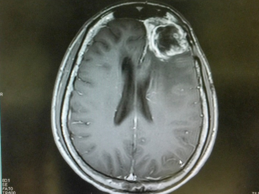 免疫療法較新突破：CD73免疫控制靶點可用來治療膠質(zhì)瘤