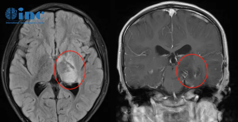 手腳抽筋、四肢僵硬、口吐白沫，孩子癲癇的原因是什么？
