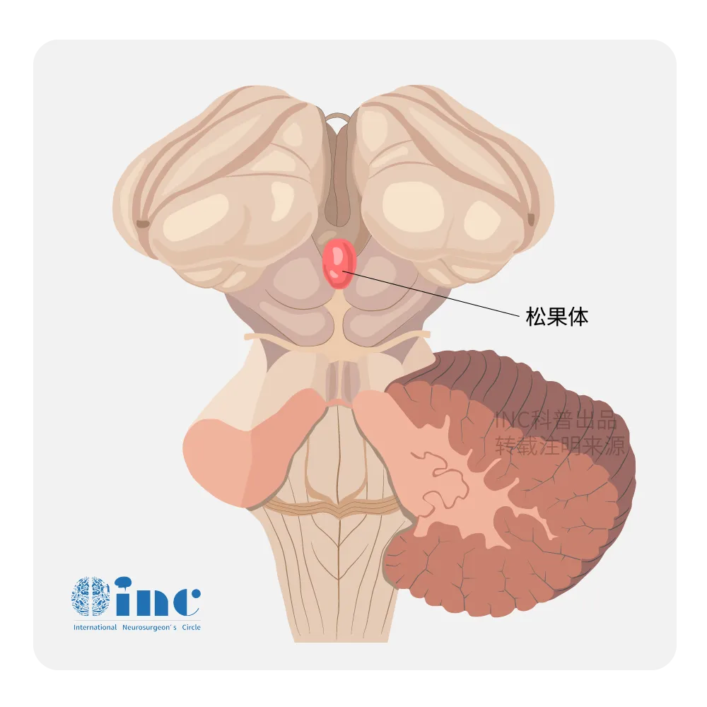 超過17種腫瘤可發(fā)生在松果體區(qū)？治療難度為何那么大？